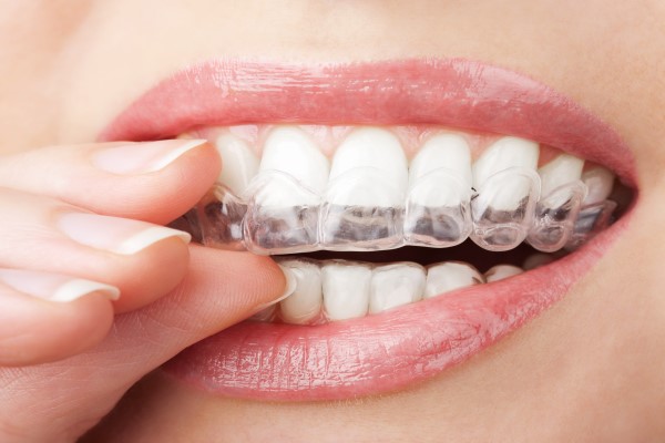 Clear Aligner Treatment By An Invisalign Dentist