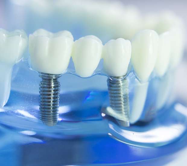 Maspeth Dental Implants