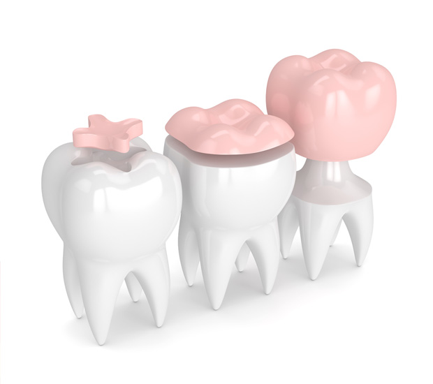 Maspeth Dental Inlays and Onlays