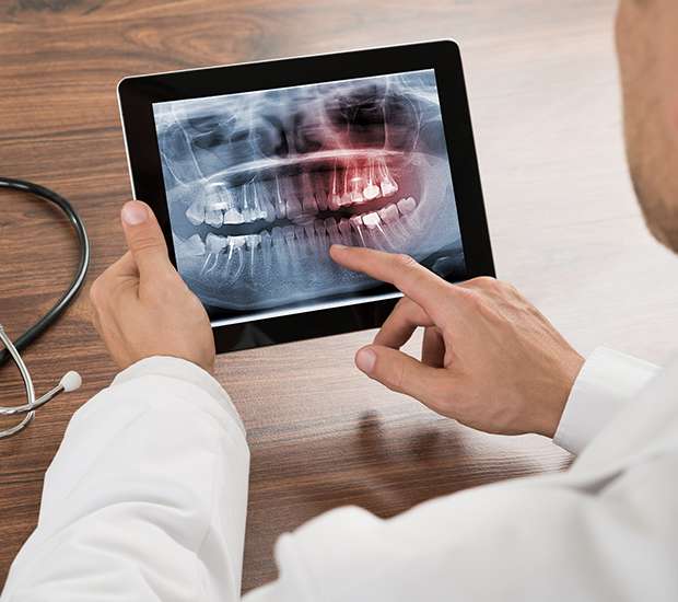 Maspeth Types of Dental Root Fractures